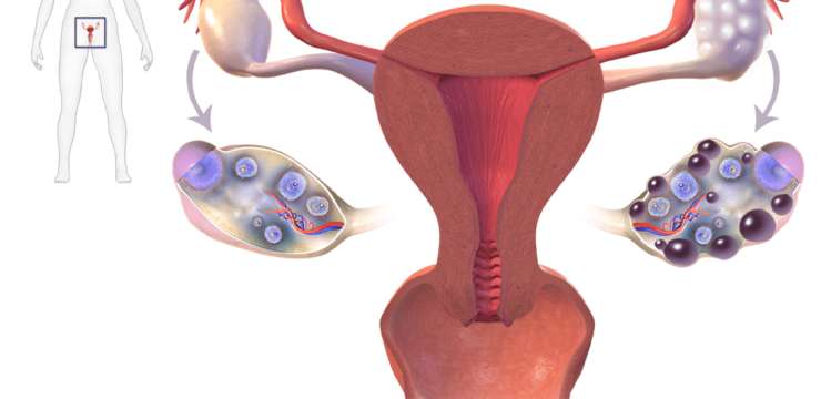 PCOS and genes