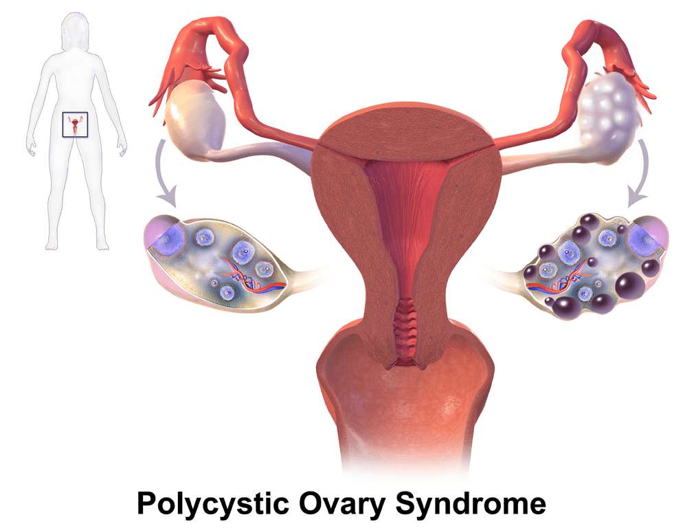 PCOS and genes