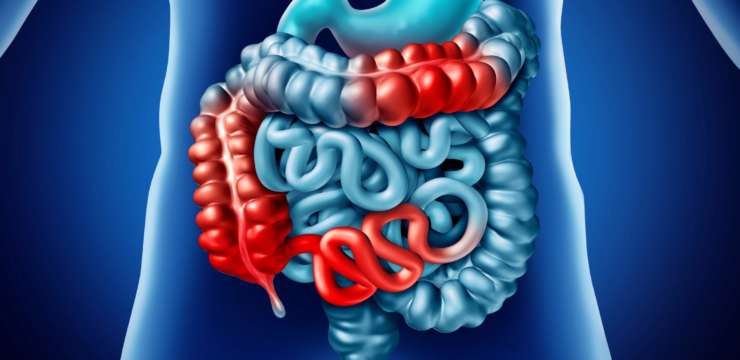 Image of inflammation in the GI tract associated with Crohn's disease.