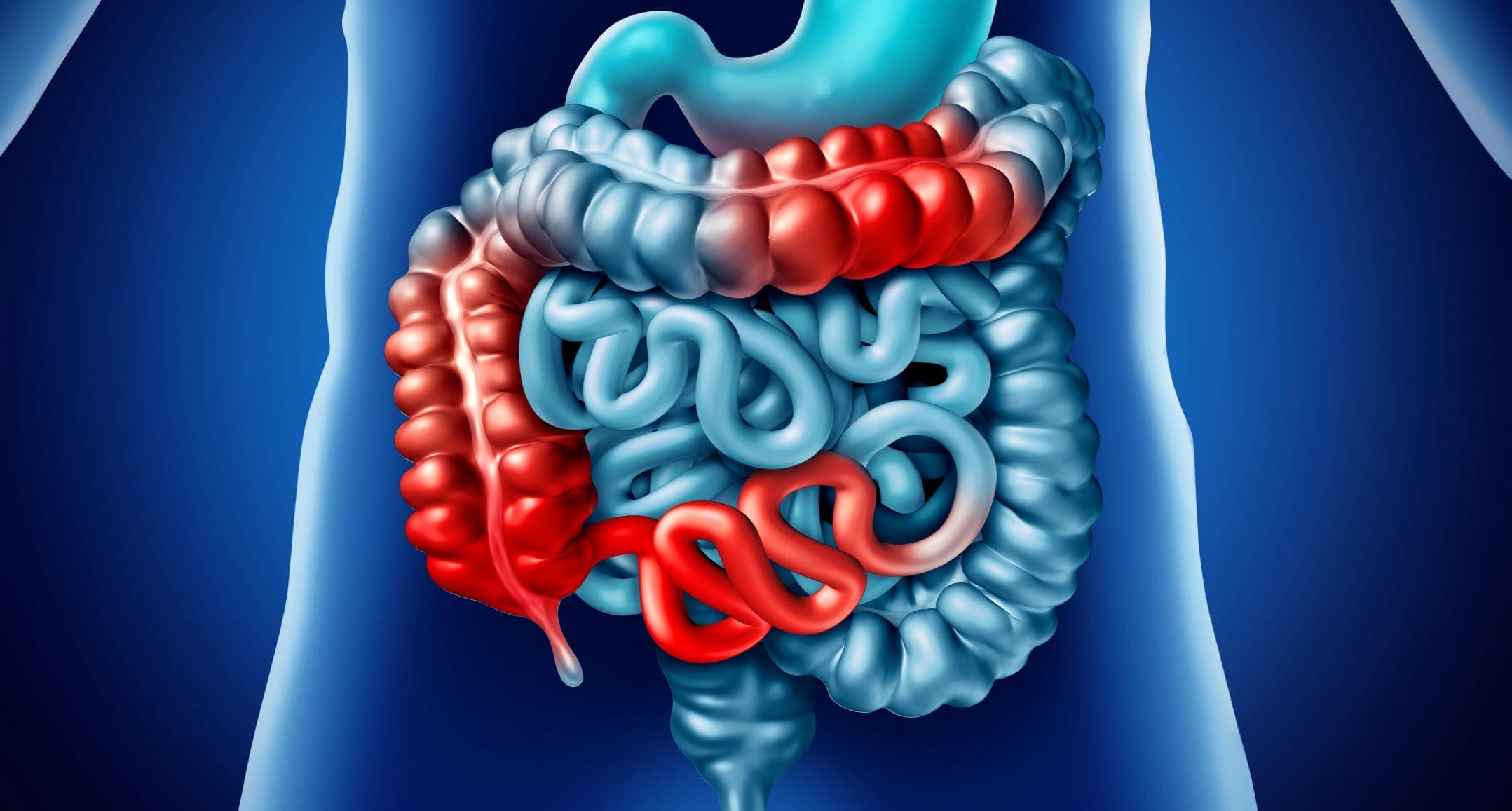 Image of inflammation in the GI tract associated with Crohn's disease.